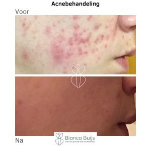 Voor en na foto acne door koperspiraal