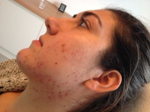 Acne in je gezicht voor de behandeling