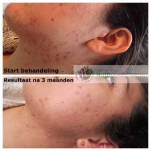 Acne in je gezicht voor behandeling en na 3 maanden