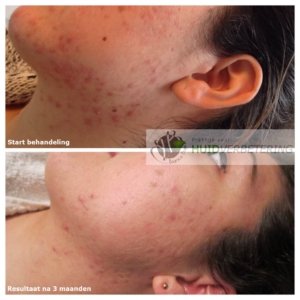 Acne in je gezicht