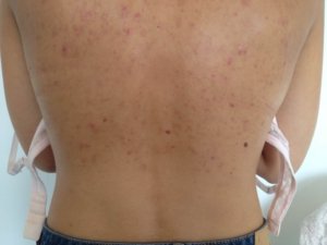 Acne, puistjes op rug