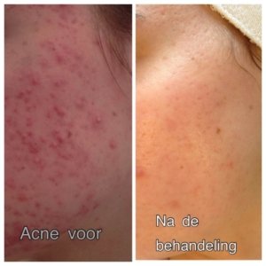 Acne voor en na behandeling