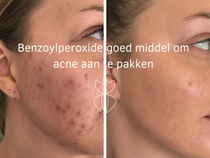 Benzoylperoxide goed middel om acne aan te pakken