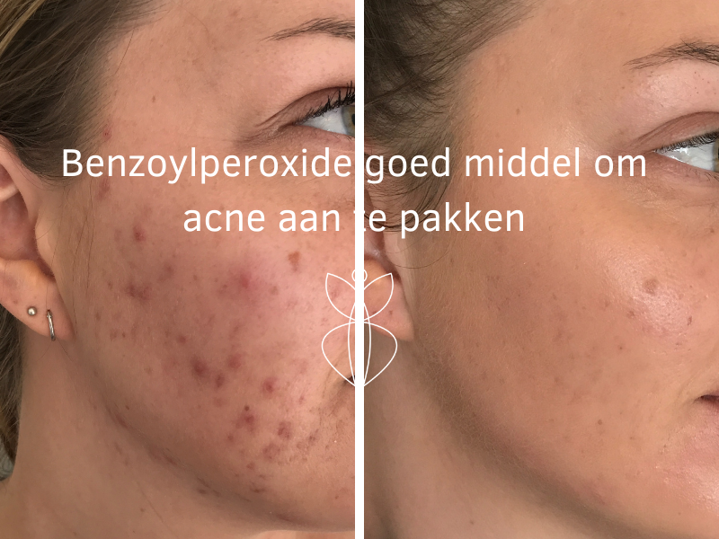 Mam afbreken Interpretatief Benzoylperoxide goed middel om acne aan te pakken - Orthomoleculair  therapeut, Specialist in huidproblemen