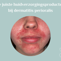 De juiste huidverzorgingsproducten bij dermatitis perioralis