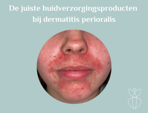 De juiste huidverzorgingsproducten bij dermatitis perioralis