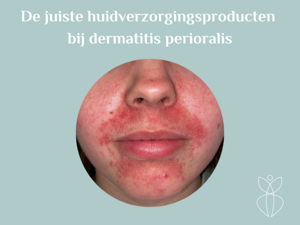 De juiste huidverzorgingsproducten bij dermatitis perioralis