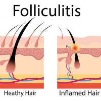 Gistpuistjes of Folliculitis is geen acne