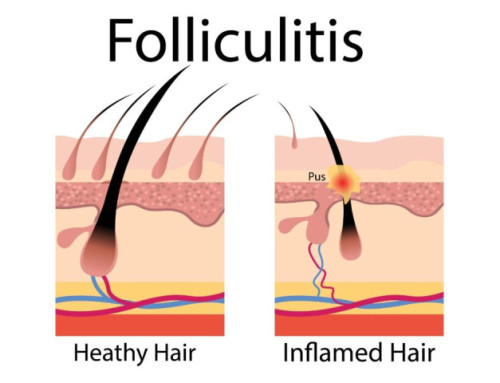 Gistpuistjes of Folliculitis is geen acne