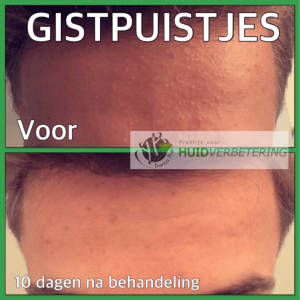 Gistpuistjes (pityrosporon folliculitis) in het gezicht ervaring van Loek