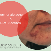 Hormonale acne op kin en PMS klachten