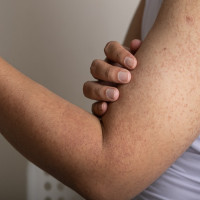 Keratosis pilaris op bovenarm