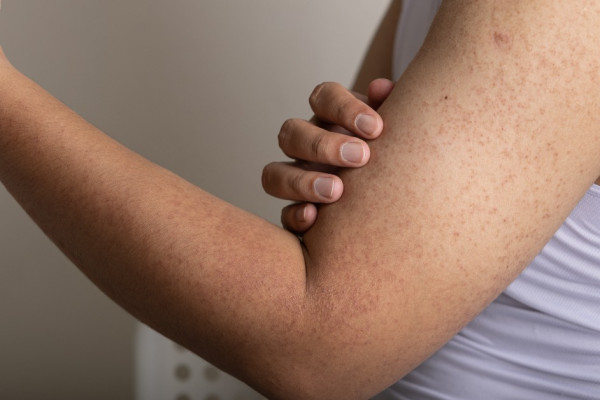 Keratosis pilaris op de bovenarm