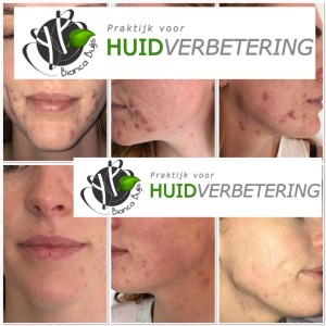 Voor en na foto acne behandeling praktijk voor huidverbetering