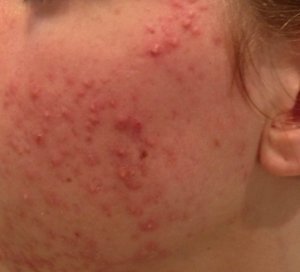 acne voor behandeling