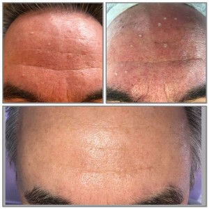 sebaceous hyperplasia verwijderen