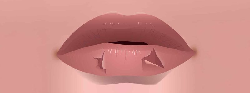 Close-up van droge, schrale lippen