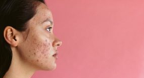 Beste behandeling tegen jeugdpuistjes in Haarlem