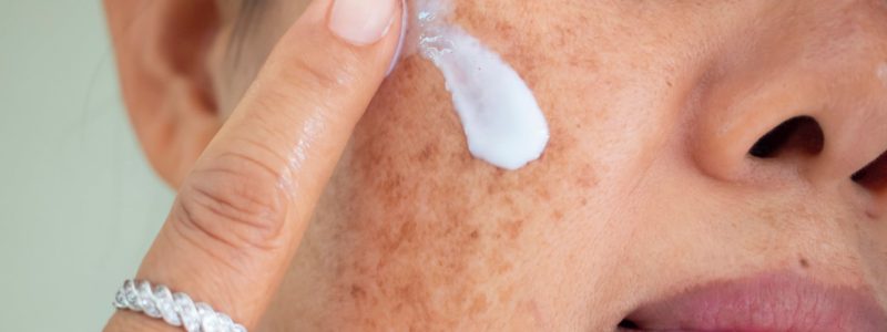 Gezicht met pigmentvlekken en het aanbrengen van crème