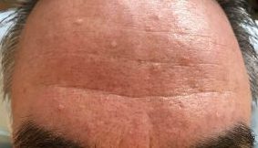 Vetbultjes gezicht verwijderen