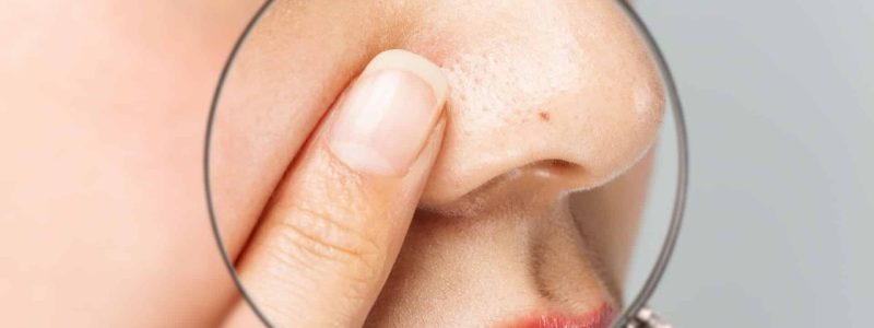 Close-up van de huid met zichtbare talgklieren