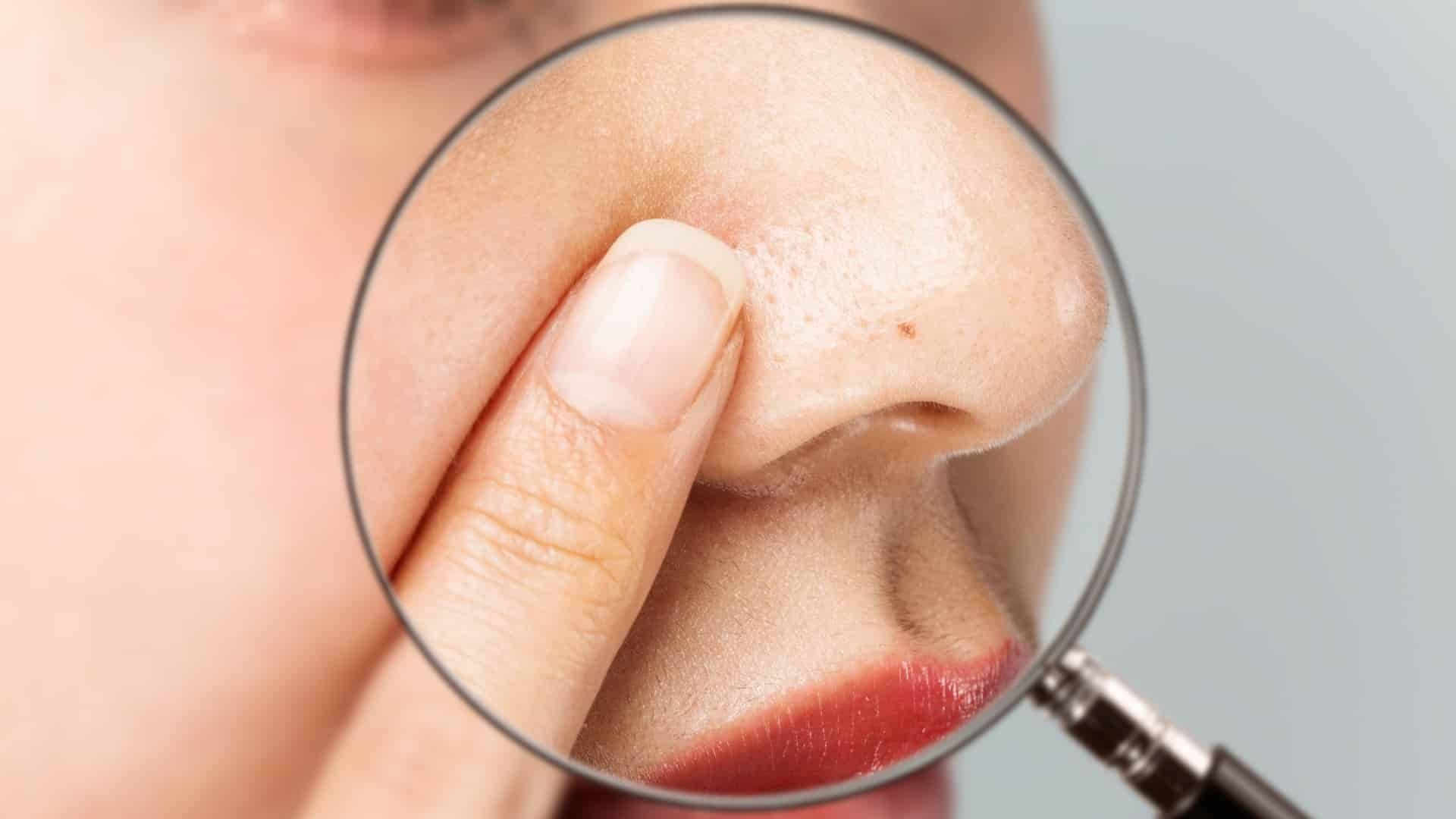 Sebatical Image Sebaceous filamenten lijken op mee-eters