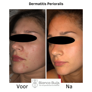 Dermatitis perioralis, clownseczeem natuurlijke behandeling