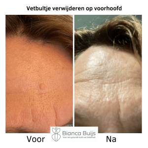Vetbultje verwijderen voor en na foto