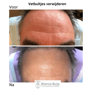 Vetbultjes gezicht verwijderen