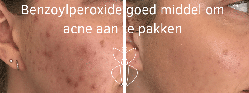 Benzoylperoxide goed middel om acne aan te pakken