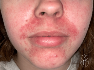 Rode geïrriteerde huid met puistjes mond, kin en neus