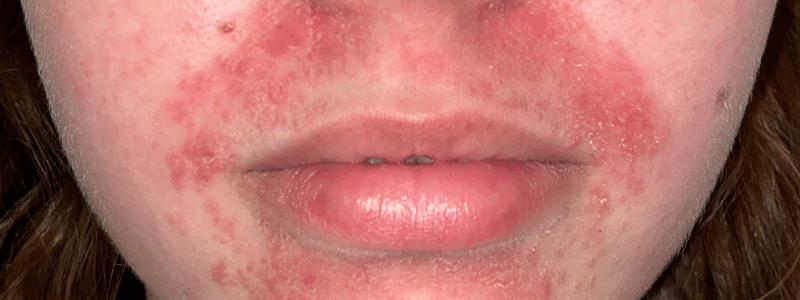 Rode geïrriteerde huid met puistjes mond, kin en neus