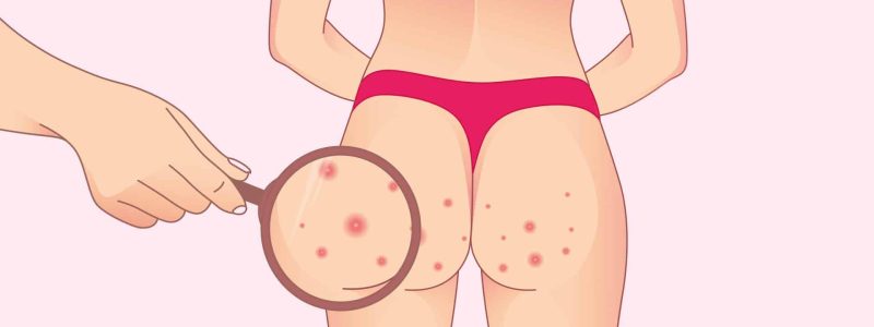 Illustratie van folliculitis op het bilgebied