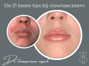 De 21 beste tips bij clownseczeem