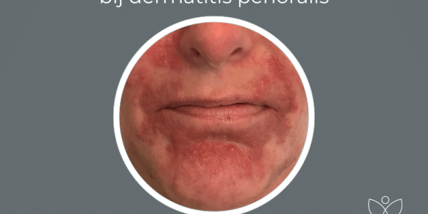 De juiste huidverzorgingsproducten bij clownseczeem