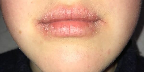 Gescheurde mondhoeken met kloofjes