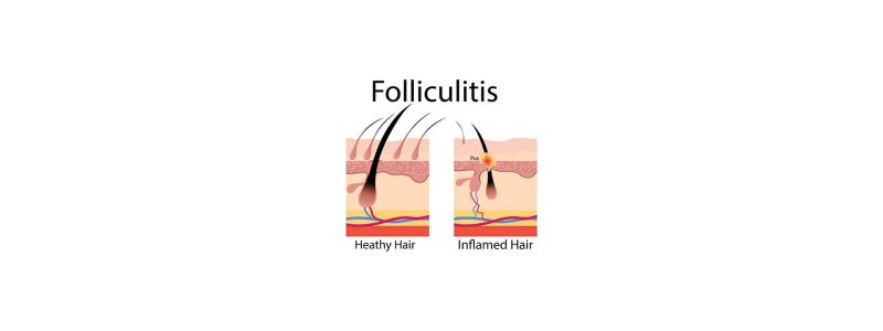 Close-up van huid met folliculitis om het verschil met acne te tonen