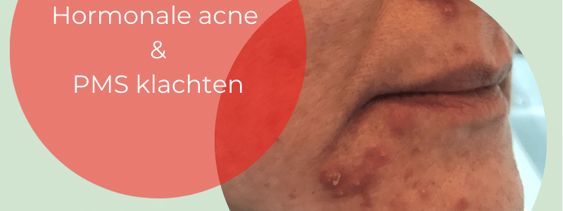 Hormonale acne op kin en PMS klachten
