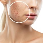 Close-up van gezicht met acne en een vergrootglas