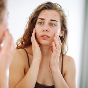 Vrouw die haar gezicht met acne onderzoekt