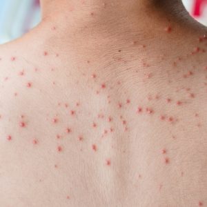 Close-up van acne op de rug