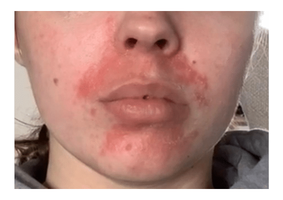 Dermatitis perioralis aanpak