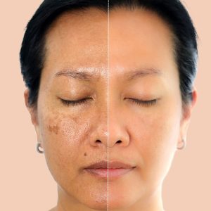 Vrouw met een donkere huid met pigmentvlekken op het gezicht