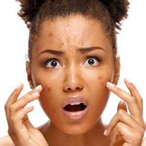 Jonge vrouw met donkere huid die acne of puistjes aanraakt