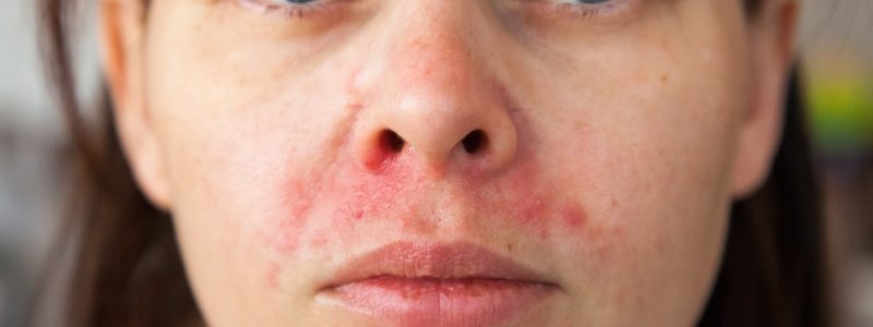 Close-up van gezicht met rode huid en clownseczeem (dermatitis perioralis)