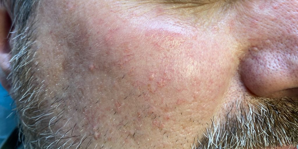 Close-up van vetbultjes en talgklierhyperplasie in het gezicht van een man met baard