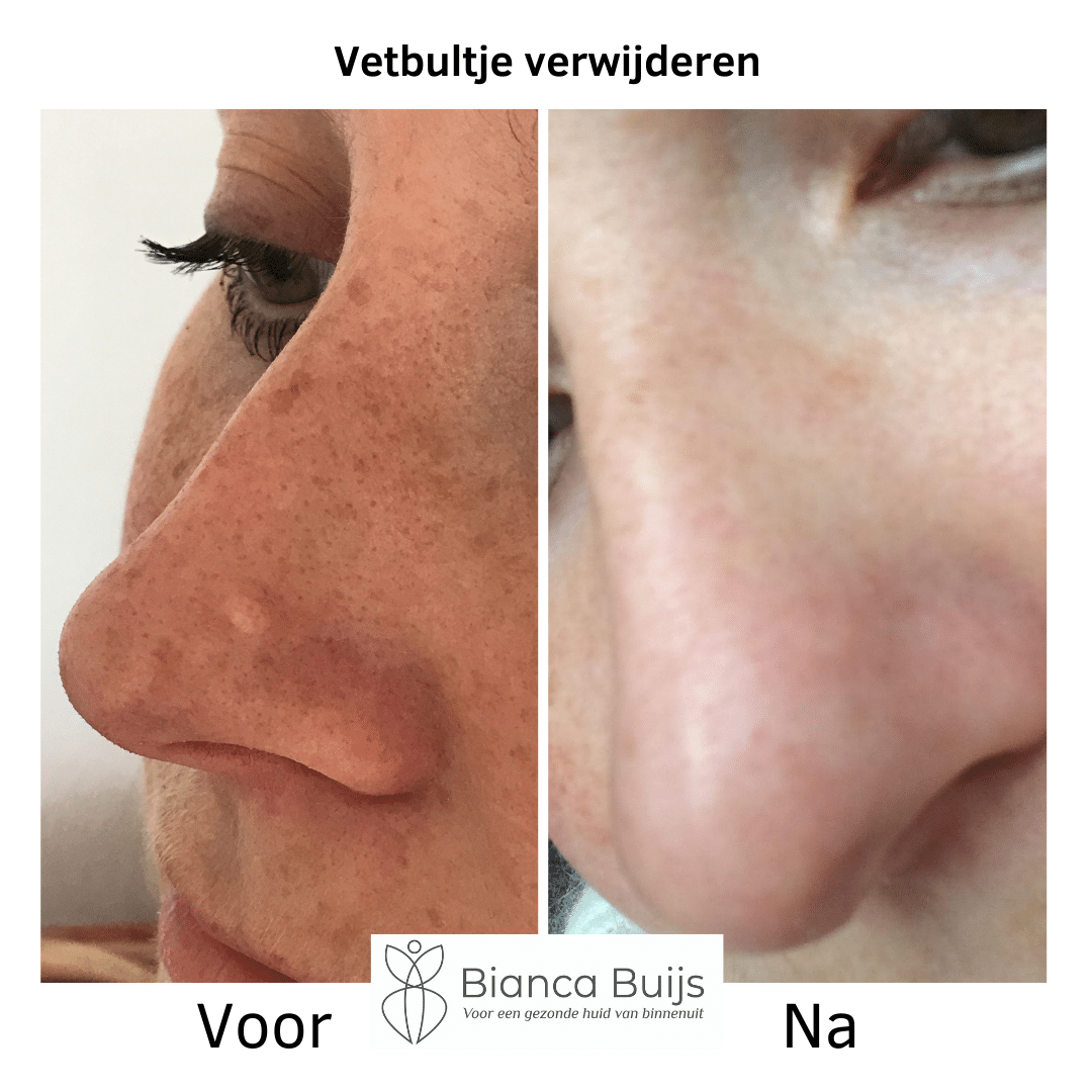 Voor en na foto van het verwijderen van een vetbultje
