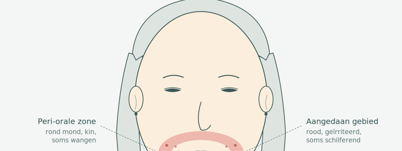 llustratie van de lokalisatie van clownseczeem (dermatitis perioralis) in de periorale zone rondom mond en kin