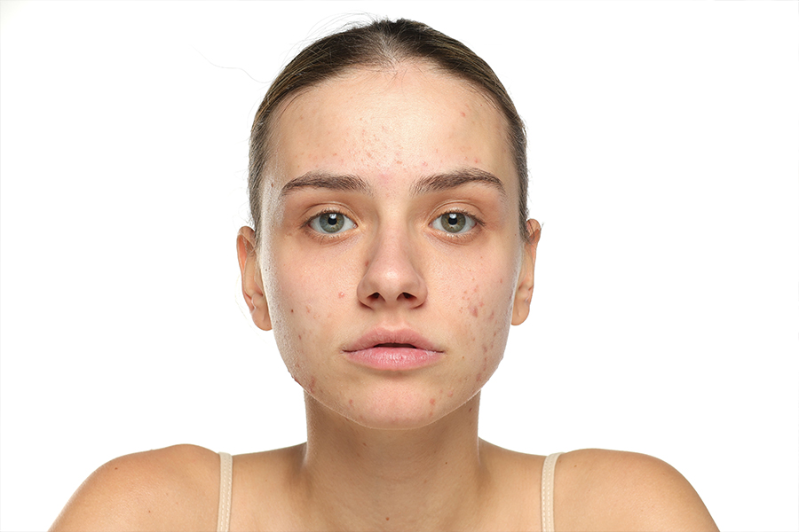 Huid met acne