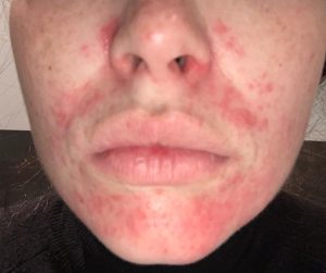 Clownseczeem rond de mond: rode bultjes en ontstoken huid door dermatitis perioralis